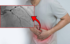 Đau thượng vị, người đàn ông phát hiện 3 nhánh mạch vành tổn thương nặng