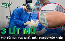 Viên sỏi hơn 1cm suýt phá hỏng quả thận người đàn ông