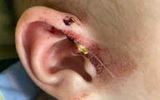 Lưỡi câu móc vào vành tai bé 10 tháng tuổi