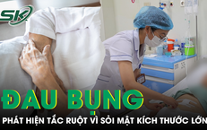 Tự điều trị đau bụng dài ngày, cụ bà tắc ruột vì sỏi mật kích thước lớn