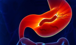 Nhiễm vi khuẩn Helicobacter pylori v&#224; nỗi lo ung thư dạ d&#224;y