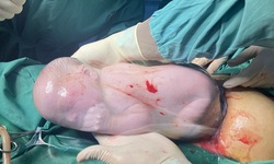 Cặp song sinh ch&#224;o đời, một b&#233; c&#242;n nguy&#234;n trong bọc ối