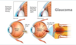 Glaucoma - &#39;Kẻ đ&#225;nh cắp&#39; thị gi&#225;c thầm lặng