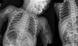 FDA phê duyệt thuốc tăng trưởng ở trẻ mắc hội chứng lùn