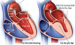 Valsartan cải thiện chức năng tim trong bệnh ph&#236; đại cơ tim