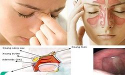 Tắc mũi, chảy m&#225;u mũi - Thận trọng với u &#225;c t&#237;nh mũi xoang