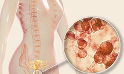 Kh&#225;ng sinh dạng gel trị vi&#234;m &#226;m đạo do vi khuẩn