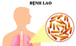 B&#224;i thuốc hỗ trợ trị lao phổi