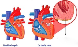 Cảnh gi&#225;c với bệnh vi&#234;m cơ tim ở trẻ