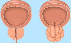 L&#224;m sao để cải thiện tiểu đ&#234;m, tiểu nhiều lần do ph&#236; đại tiền liệt tuyến?