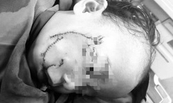 B&#233; 3 tuổi ở Nghệ An bị ch&#243; nh&#224; cắn nhập viện