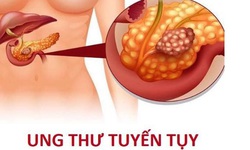 Hiệu quả từ phối hợp thuốc mới trong điều trị ung thư tuyến tụy
