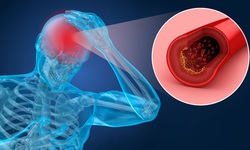 Ai dễ bị thiếu m&#225;u n&#227;o?