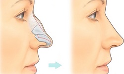 Gãy xương mũi – Nhận biết và cách xử trí