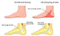 Đau g&#243;t ch&#226;n, chữa như thế n&#224;o?