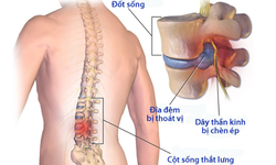 B&#224;i tập ph&#242;ng ngừa v&#224; phục hồi hội chứng đau thắt lưng