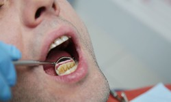 4 c&#225;ch loại bỏ cao răng tại nh&#224;