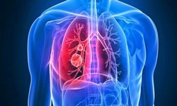 Thuốc trị ung thư, triển vọng trong điều trị xơ phổi v&#244; căn