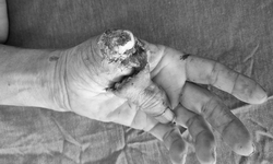 Hải Dương: Lần đầu tiên nối thành công ngón tay đứt rời bằng kĩ thuật vi phẫu