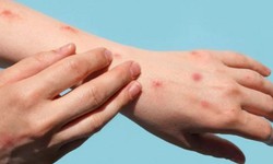 Nhiễm HIV v&#224; nguy cơ mắc bệnh đậu m&#249;a khỉ trầm trọng