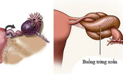 Giải đ&#225;p thắc mắc: U nang buồng trứng c&#243; nguy hiểm kh&#244;ng?