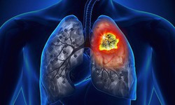 Những triệu chứng cảnh b&#225;o ung thư phổi bạn cần biết