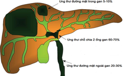 Ph&#225;c đồ mới điều trị ung thư đường mật trong gan