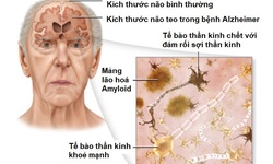 K&#237;ch hoạt gen, liệu ph&#225;p c&#243; thể điều trị bệnh Alzheimer trong tương lai