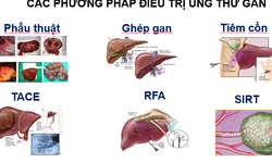 Điều trị và dự phòng ung thư biểu mô tế bào gan