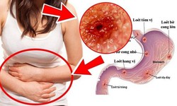 Giải ph&#225;p hỗ trợ vi&#234;m lo&#233;t dạ d&#224;y t&#225; tr&#224;ng từ dược liệu cổ truyền
