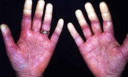 Hội chứng Raynaud l&#224; g&#236;, chữa thế n&#224;o?