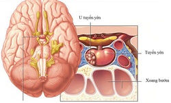 Đau đầu, tay ch&#226;n đau buốt, to l&#234;n bất thường… cảnh gi&#225;c với bệnh to đầu chi