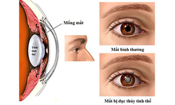 C&#225;ch chăm s&#243;c mắt sau mổ đục thủy tinh thể ở người cao tuổi