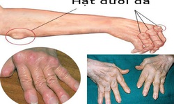 Sử dụng đ&#250;ng thuốc chống vi&#234;m trong điều trị vi&#234;m khớp dạng thấp 
