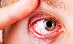 Dấu hiệu căn bệnh nhiễm tr&#249;ng mắt nguy hiểm c&#243; thể g&#226;y mất thị lực, kho&#233;t bỏ nh&#227;n cầu