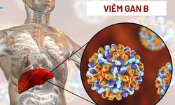 Nhiễm virus vi&#234;m gan B sau bao l&#226;u th&#236; xuất hiện triệu chứng v&#224; tiến triển th&#224;nh ung thư gan?
