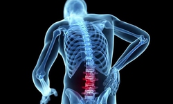 Nhận biết biến chứng nguy hiểm của bệnh lao cột sống