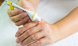 Kh&#244;ng t&#249;y tiện d&#249;ng thuốc chữa vi&#234;m da mủ 