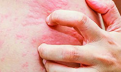 Dị ứng thực phẩm, không chỉ là phiền toái…
