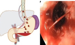 C&#225;ch ph&#225;t hiện sớm v&#224; dự ph&#242;ng gi&#227;n tĩnh mạch thực quản nguy hiểm ở bệnh nh&#226;n xơ gan 