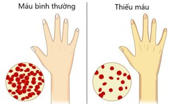 Điều trị thiếu m&#225;u như thế n&#224;o?