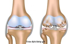Tr&#224;n dịch khớp gối v&#224; những hệ lụy