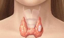 Phụ nữ mắc bướu gi&#225;p đa nh&#226;n c&#243; nguy hiểm?