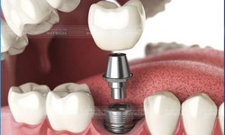 Những lưu &#253; trước v&#224; sau khi trồng răng Implant bạn cần biết