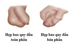 Hẹp bao quy đầu ở trẻ em v&#224; người lớn