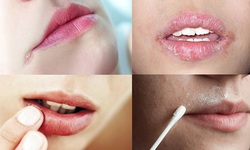 Thuốc điều trị chốc m&#233;p