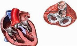 Bệnh thấp tim (thấp khớp cấp) d&#249;ng thuốc g&#236; để chữa?