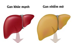 Vitamin B12 c&#243; thể gi&#250;p giảm gan nhiễm mỡ kh&#244;ng do rượu