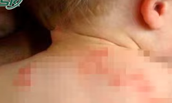 B&#225;o động bệnh chốc lở l&#226;y lan mạnh khi trẻ tựu trường