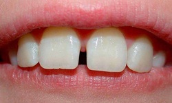 Răng thưa v&#224; c&#225;ch khắc phục